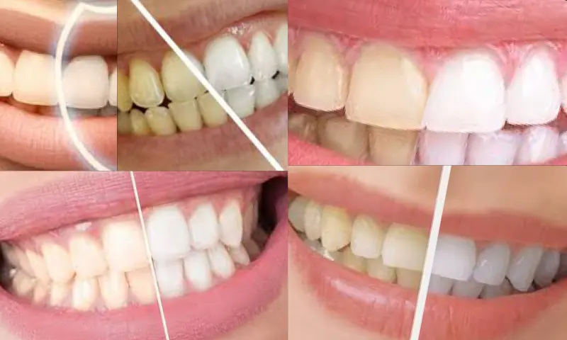 Ortodontik Tel Tedavisi