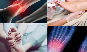 Düz Tabanlık Tedavisinde Doğru Uzman Seçimi Neden Önemlidir?