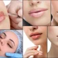 What Are Lip Filling Techniques?