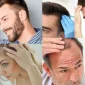 Hair Transplant Saç Ekimi
